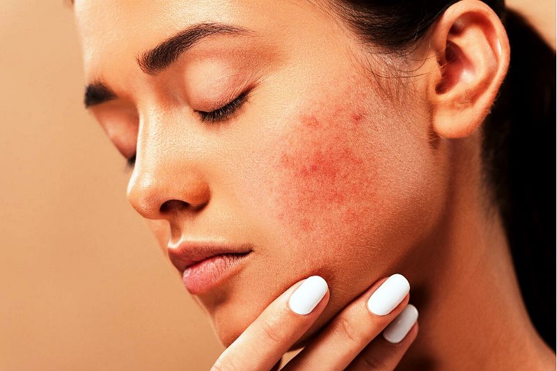 illustration: woman with facial acnes